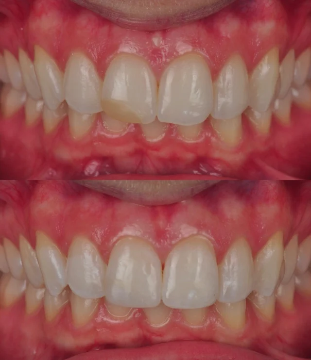 Transformamos sonrisas, restauramos confianza.

Hoy queremos compartir el resultado de una restauración estética dental. Nuestro paciente llegó con una restauración antigua y tras un tratamiento personalizado, logramos devolverle una sonrisa natural, armónica y saludable.

Las restauraciones estéticas no solo mejoran la apariencia, también cuidan la función dental y la autoestima.

¿Te gustaría mejorar tu sonrisa? Agenda tu valoración y descubre cómo podemos ayudarte.

#OdontologíaEstética #SonrisaPerfecta #RestauraciónDental #AntesYDespués #EstéticaDental #Dentista #SonríeConConfianza #vallesvallesclinicadental
